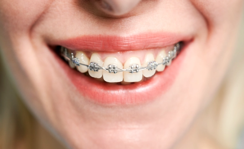 L'orthodontie pour adolescents au cabinet des Drs Hildwein & Muller-Tritschler