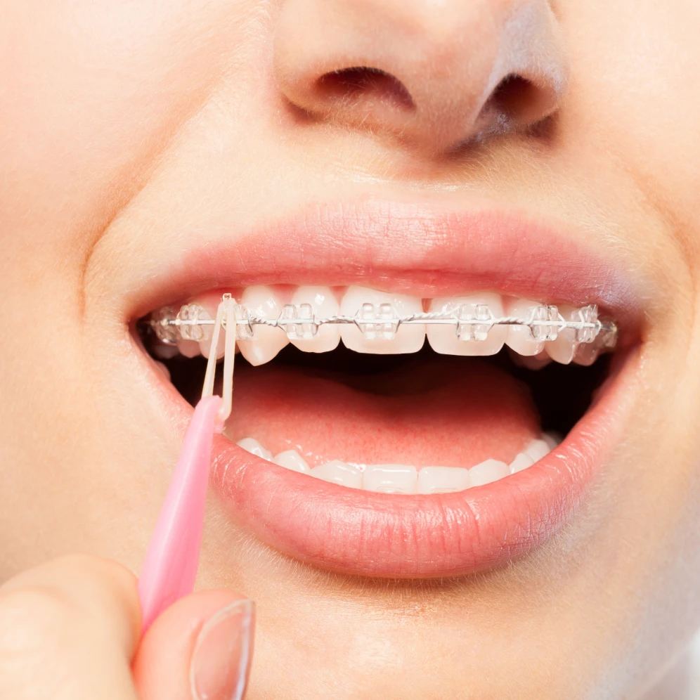 Comprenez l'utilité des élastiques en orthodontie au cabinet du Dr Hildwein